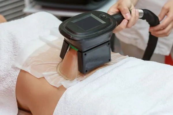 Image of person having fat freezing treatment to help weight gain Stratford