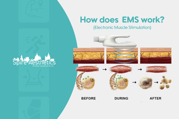 EMS treatment for post pregnancy weight loss treatment Stratford