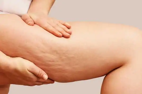 Image of woman showing leg with cellulite Stratford