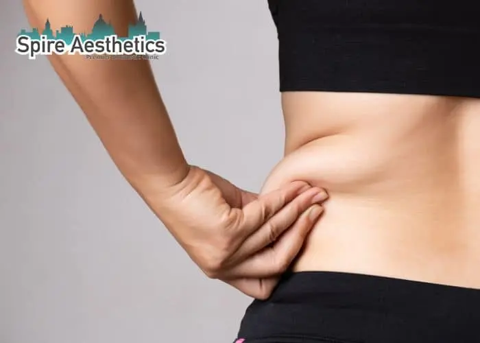 Image of woman pinching fat on their hips Stratford. Fat Freezing treatment