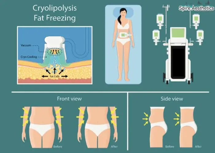 Fat freezing treatment Stratford benefits for competitions to remove stubborn fat deposits.
