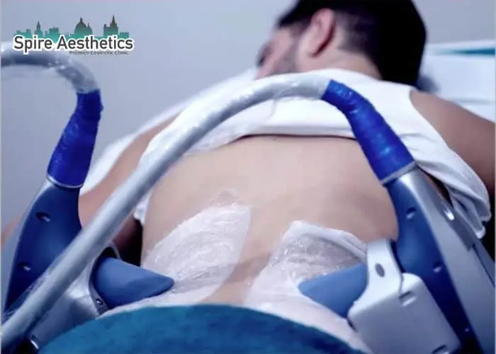 Man having fat freezing treatment done on love handles before a competitions Stratford to create a sculpted look.