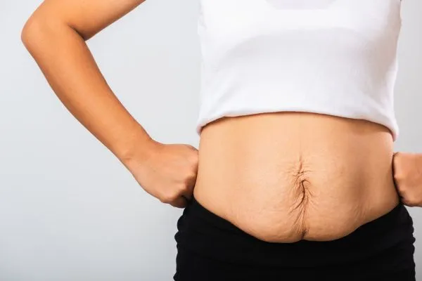 Image of a woman's stomach after weight loss with sagging skin following a gastric band Stratford