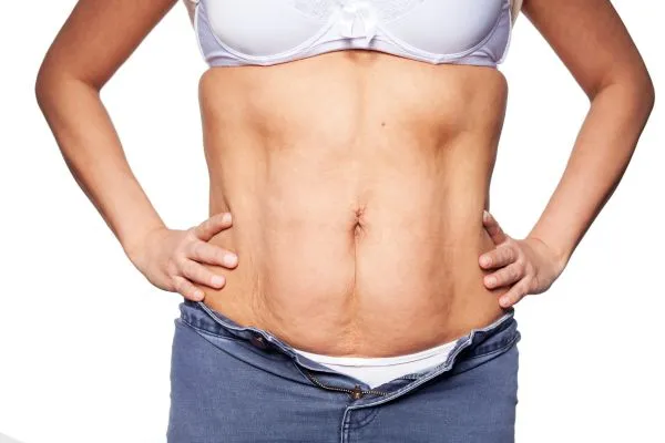 sagging skin on woman's stomach after weight loss injections Stratford