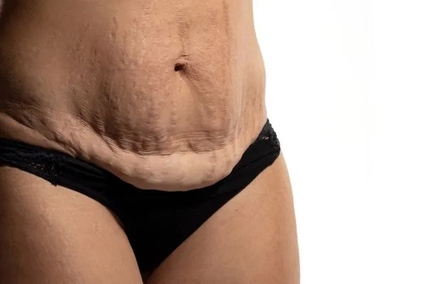 Image of womans stomach after weight loss injections Stratford showing saggy skin