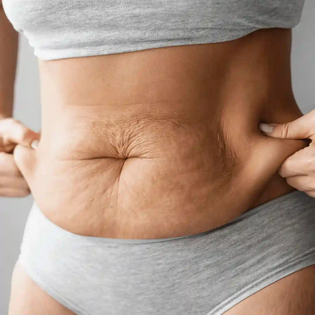 Is It Normal to Have Loose Skin After Pregnancy Stratford?