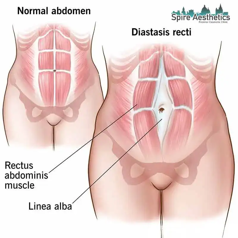 When Will My Belly Feel Normal Again Stratford?