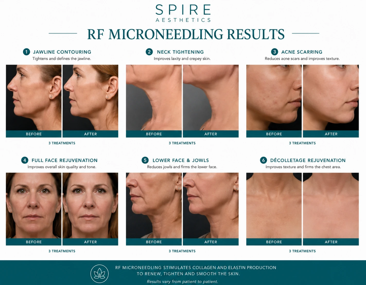 RF Microneedling Skin tightening Stratford results