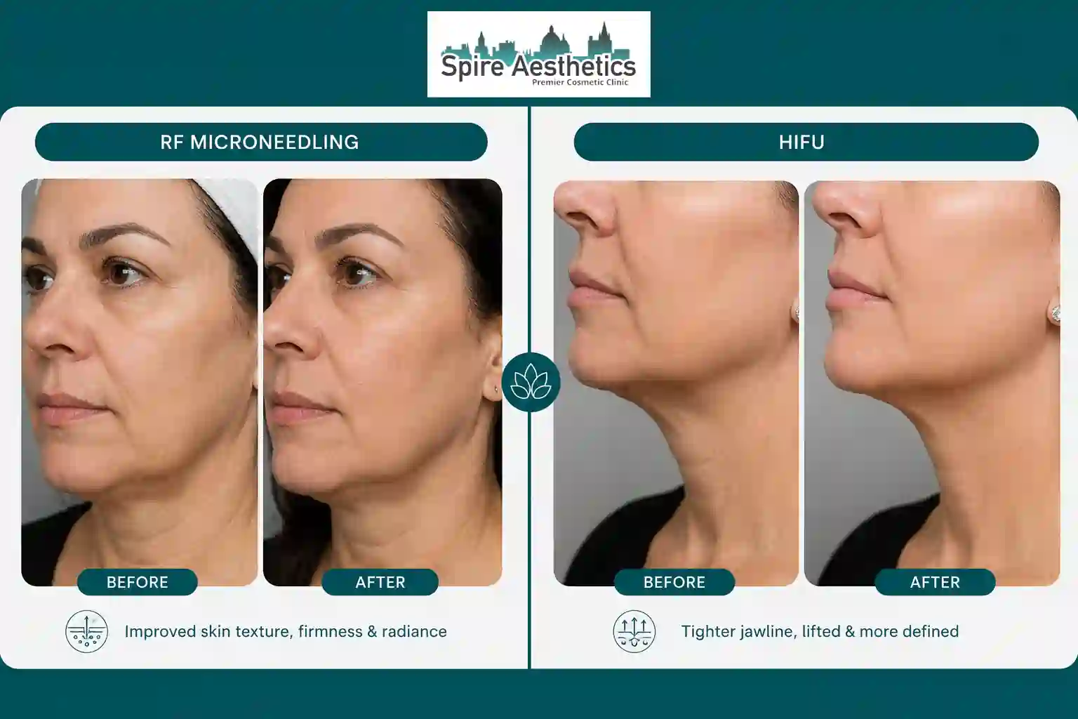 Can RF Microneedling and HIFU Be Combined Stratford?