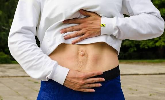 When Could Diastasis Recti Be the Missing Piece of the Puzzle Stratford?