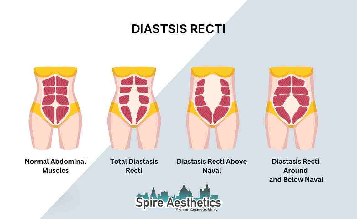 Is Non-Surgical Diastasis Recti Treatment Right for You? Common Concerns Answered Stratford
